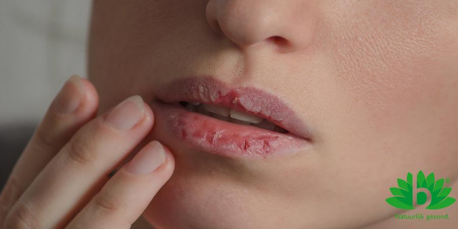 Droge lippen? Zo houd je ze vochtig!