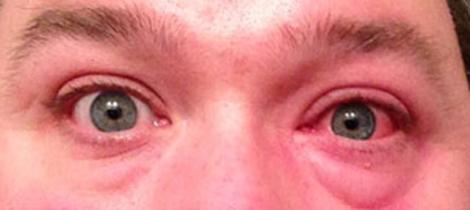 Pollen: dé veroorzaker van jouw hooikoortsklachten