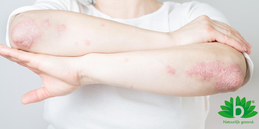 Pijn en jeuk door huidafwijking psoriasis