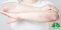 Pijn en jeuk door huidafwijking psoriasis