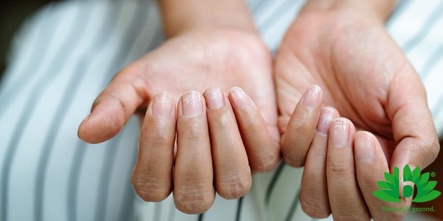 7 veelvoorkomende nagelproblemen