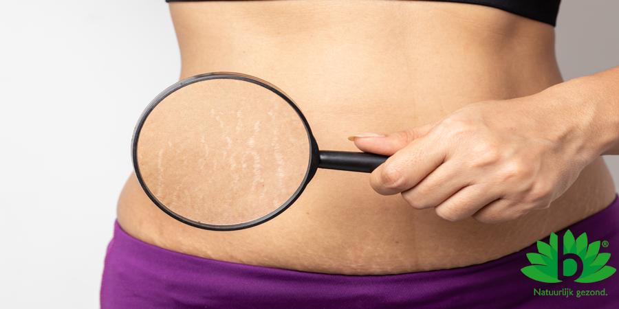 Wat is striea en hoe zorg je ervoor dat je geen striemen op je huid krijgt