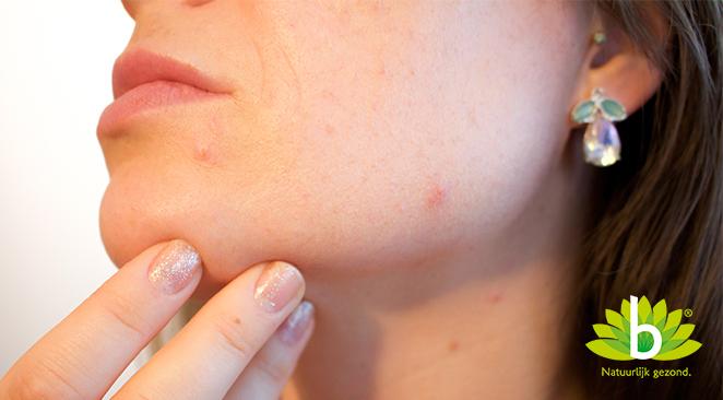 Acne: wat is het en hoe kom je er vanaf?