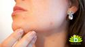 Acne: wat is het en hoe kom je er vanaf?