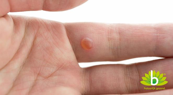 De wrat: onschuldig maar hardnekkig